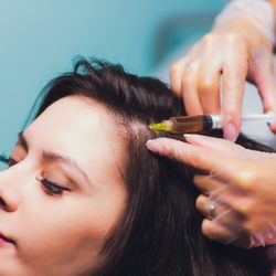 PRP is loaded with growth factors that promote rapid angiogenesis and localized cell growth when it is injected into the scalp.