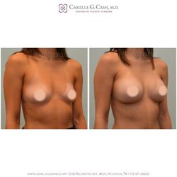 Camille Cash, M.D - Before and 4 months after breast augmentation with 295 cc implants