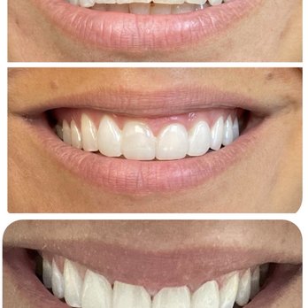 Midtown Dental Group - Veneers (before , temporaries, final ) - Cosmetic Dentists Near Me - New York, New York Midtown Dental Group - Veneers (before , temporaries, final ) - Cosmetic Dentists Near Me - New York, New York