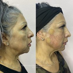 Bellissima Skin - MINT PDO Threads and RHA 4 Filler