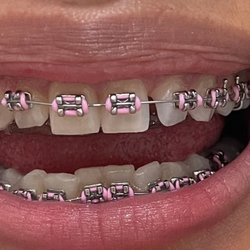 Ventura County Orthodontics - Day 1 of braces