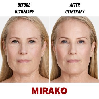 Mirako Spa - Ultherapy - Medical Spas Near Me - Brea, California Mirako Spa - Ultherapy - Medical Spas Near Me - Brea, California