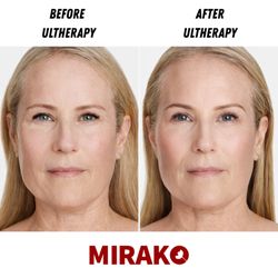 Mirako Spa - Ultherapy