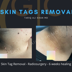 GentleCare Laser Aesthetics - Safely and effectively remove skin tags
