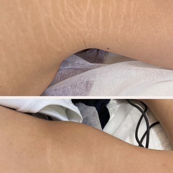 The Courtyard Salon - Stretch Mark Camouflage
After 1st session
By Julie
Forever Beauty - Hair Salons Near Me - Benicia, California The Courtyard Salon - Stretch Mark Camouflage
After 1st session
By Julie
Forever Beauty - Hair Salons Near Me - Benicia, California
