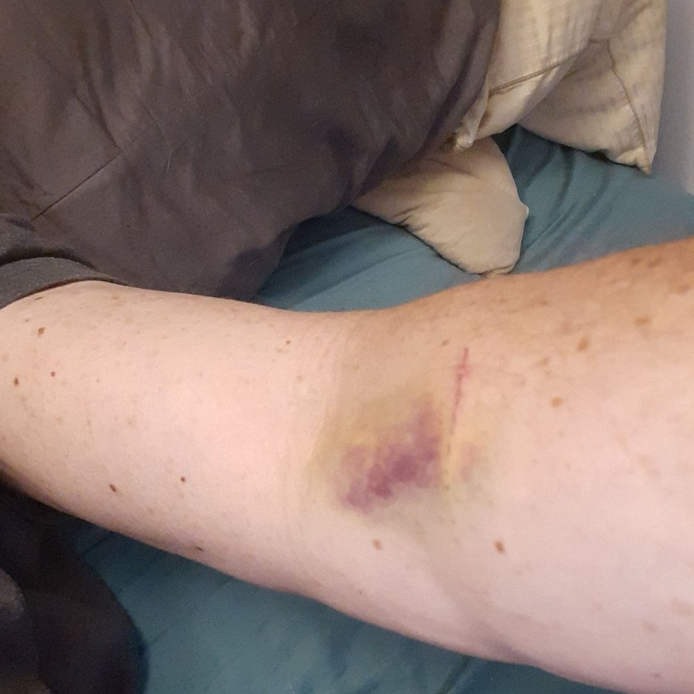 Quest Diagnostics - Bruise from drawing of blood - Laboratory Testing Near Me - Rockville Centre, New York Quest Diagnostics - Bruise from drawing of blood - Laboratory Testing Near Me - Rockville Centre, New York