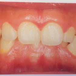 John J Eisinger Orthodontics, DDS - Initial Bite