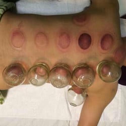 Club 24 spa - Cupping