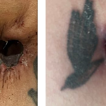 Paydar Plastic Surgery: Keyian Z Paydar, MD - belly button about two weeks post op vs seven weeks post op - Plastic Surgeons Near Me - Newport Beach, California
