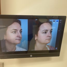 Before & after rhinoplasty Before & after rhinoplasty