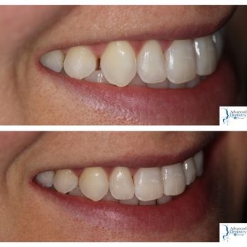 Advanced Dentistry by Design - Conservative use of composite bonding to close a gap between teeth - General Dentistry Near Me - San Jose, California