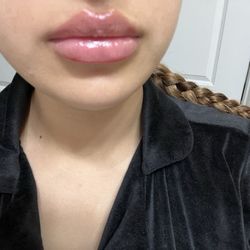 Dominion Medspa & Salon - My lips 9 days after filler