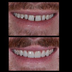 Foothill Ranch Dentistry by Dr.Aria Irvani - Closing spaces with meticulously crafted veneers.