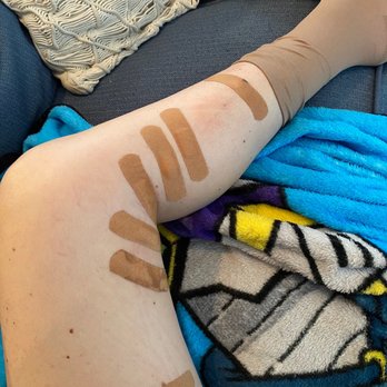 USA Vein Clinic - The first photo were my healthy legs that they did a ablations on. - Vascular Medicine Near Me - Annapolis, Maryland