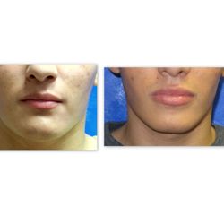 Edmund Fisher, MD, FACS - Before and after Juvederm to lips