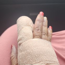 Atlanta Hand Specialist - Right after surgery before I left from the recovery room.