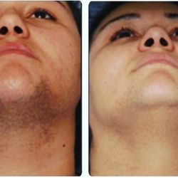 Natural Radiance Spa - Laser hair removal