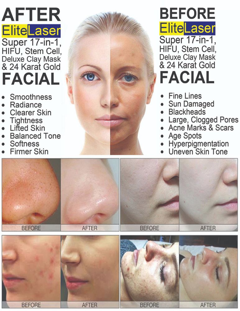ELITE LASER HAIR REMOVAL SERVICES Updated October 2024 Request an