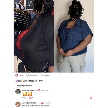 John A Paro, M.D - Before and after breast reduction - Plastic Surgeons Near Me - Dublin, California John A Paro, M.D - Before and after breast reduction - Plastic Surgeons Near Me - Dublin, California