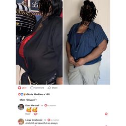 John A Paro, M.D - Before and after breast reduction
