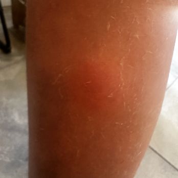 Valley Presbyterian Hospital - Massive welt from lobby mosquitos - Hospitals Near Me - Van Nuys, California Valley Presbyterian Hospital - Massive welt from lobby mosquitos - Hospitals Near Me - Van Nuys, California