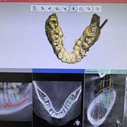 Wong Dental - Implant planning to surgery with cone bean CT!