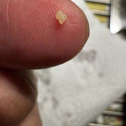 BLUSH Dental Studio - The filling that just fell out.