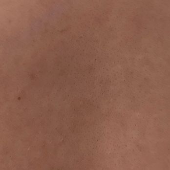 Lanoi Dermatology - 3 bumps total - Dermatologists Near Me - San Diego, California Lanoi Dermatology - 3 bumps total - Dermatologists Near Me - San Diego, California
