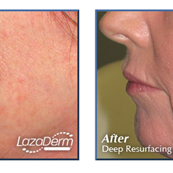 Lazaderm - Erbium laser resurfacing
