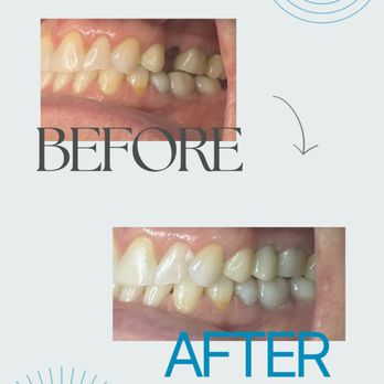 Eastport Dental - Implant and implant crown. - Cosmetic Dentists Near Me - Mesa, Arizona Eastport Dental - Implant and implant crown. - Cosmetic Dentists Near Me - Mesa, Arizona