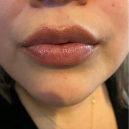 Lip filler result!