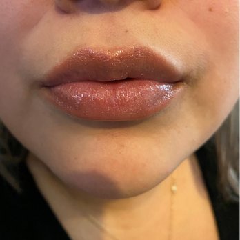 Skin Theory - Lip filler result! - Laser Hair Removal Near Me - Corona, California