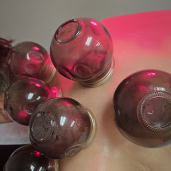 BodyMind AcuBalance - Firecupping - Acupuncture Near Me - Garden Grove, California BodyMind AcuBalance - Firecupping - Acupuncture Near Me - Garden Grove, California