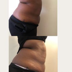 Her Figure Body & Skin Studio - Cavitation/ Skin Tighten 2 sessions