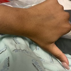 Baylor University Medical Center Station - Bruised on hand