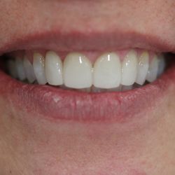 Beach Town Braces - After