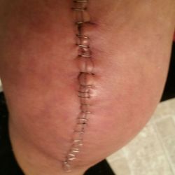 Barry A. Rose, MD - I love you Dr. Rose!  Not yet.  Still I'm pain. But, recovery is important.  Getting my life back,  priceless.
