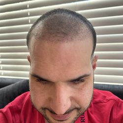 Robotic Hair RX - Post op hairline