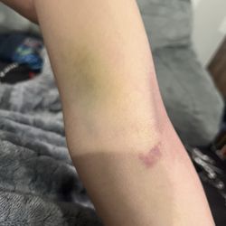 HCA Houston - They hurt my vein and this is a week after visit