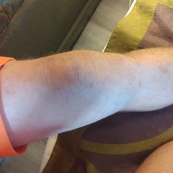 Dr Kerry R Lewis MD - Out of the blue it just started to swell up like it had fluid on it then I put a knee brace on it and it started bruising like this