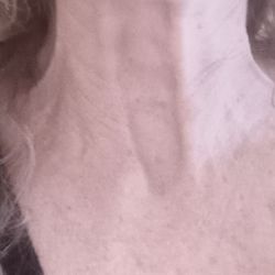 Sherris David - This is AFTER a necklift