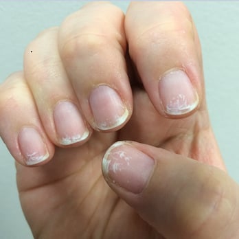Top Solar Nails - My nails AFTER if had fixed up the ragged edges a bit. Just awful. - Nail Salons Near Me - Tualatin, Oregon Top Solar Nails - My nails AFTER if had fixed up the ragged edges a bit. Just awful. - Nail Salons Near Me - Tualatin, Oregon
