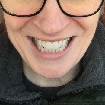 Winning Smile Dental Group - My coffee-stained teeth AFTER a "regular" cleaning at Winning Smile! - Cosmetic Dentists Near Me - Evanston, Illinois Winning Smile Dental Group - My coffee-stained teeth AFTER a "regular" cleaning at Winning Smile! - Cosmetic Dentists Near Me - Evanston, Illinois