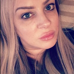 Botox Botixue - After my second unit of lip filler