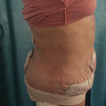 Goals Aesthetic and Plastic Surgery - My body right after the BBL Massage still love information - Plastic Surgeons Near Me - Los Angeles, California Goals Aesthetic and Plastic Surgery - My body right after the BBL Massage still love information - Plastic Surgeons Near Me - Los Angeles, California