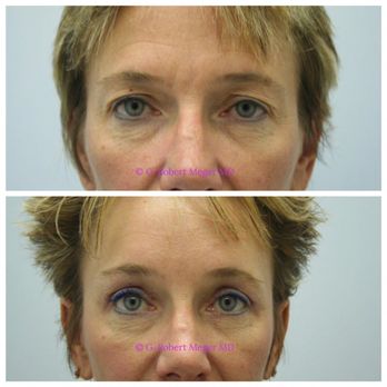 Robert Meger, MD - Endoscopic Browlift - Cosmetic Surgeons Near Me - Scottsdale, Arizona