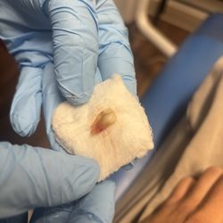 Western Dental & Orthodontics - Extracted tooth