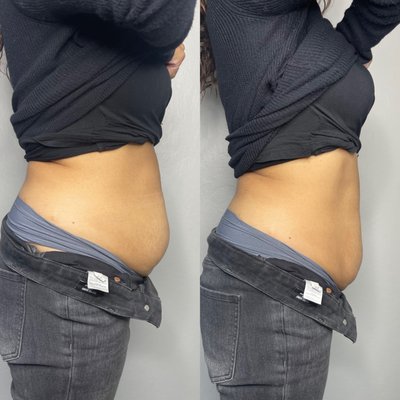 EMSculpting - Clients wanted to improve stubborn abdominal fat and create a more sculpted waistline without surgery. These before-and-after photos show the progress from their treatment plan. Results vary from person to person, but we’re always focused on creating natural-looking improvements while helping clients maintain their results with healthy habits.