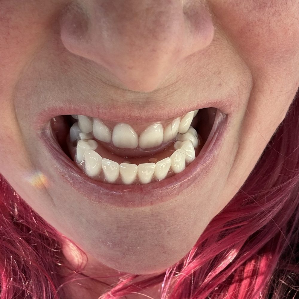 Affordable Dentures & Implants - The underbite from the teeth they made - Cosmetic Dentists Near Me - Windsor, California