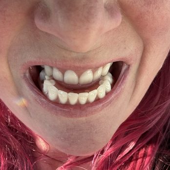 Affordable Dentures & Implants - The underbite from the teeth they made - Cosmetic Dentists Near Me - Windsor, California